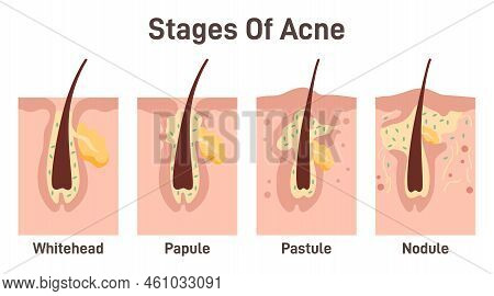 Acne Development Stages. Inflamed Skin Pimples. Plugged Hair Follicles