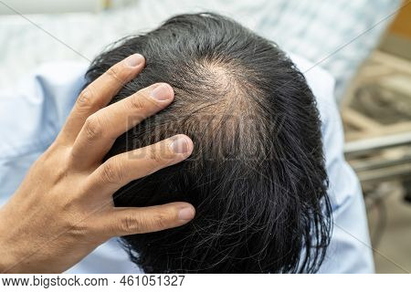 Bald In The Middle Head And Begin No Loss Hair Glabrous Of Mature Asian Business Smart Active Office