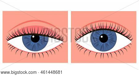 Comparison Eye With Down Lid Ptosis And Healthy Eye. Blepharoplasty, Eyelid Surgery. Correction Aest