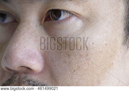 Close Up Asian Man Face With Freckles Dark Spots From Uv Light , Skin Care And Health Problem Concep