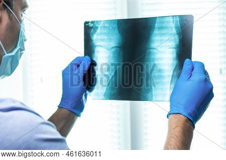Doctor Hold In Hands X-ray Film. Oa Knee X-ray Image Posteo-anterior View, Oa Knee Diagnosis.