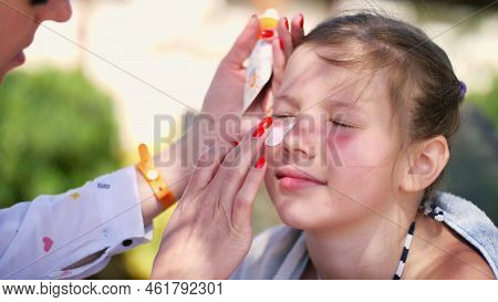 Close-up, The Child, Girls, Severe Sunburn On The Face. Mom Smears Places Of Burns Abundantly With A