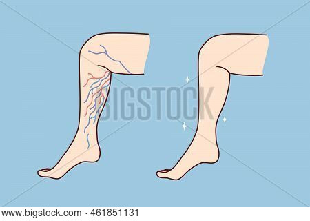 Close-up Of Unhealthy And Healthy Leg With Varicose Veins. Patient Suffer From Varicoses. Healthcare