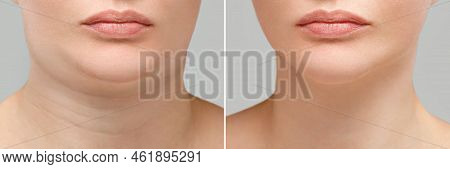Female Double Chin Before And After Correction. Correction Of The Chin Shape Liposuction Of The Neck