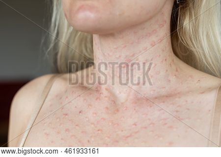 Real Biorevitalization Of The Skin On A White Background. Traces Of Injections Of Biorevitalization 