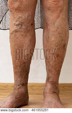 Senior Woman Bare Legs With Protruding Varix, Spider Varicose Veins Medical Condition. Skin Dermatol