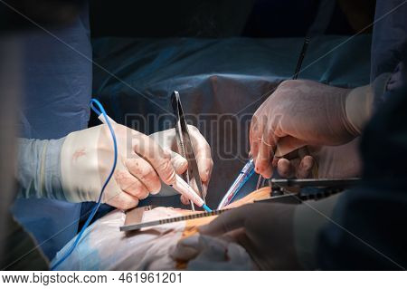 Closeup Of Professional Doctor Hands Operating A Patient During Open Heart Surgery In Surgical Room.