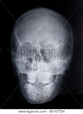 X-ray of a deformed skull