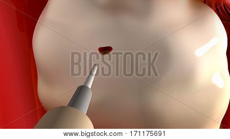 Laparoscopic ovarian drilling is a surgical treatment that can trigger ovulation in women who have polycystic ovary syndrome (PCOS). Electrocautery or a laser is used to destroy parts of the ovaries. 3D