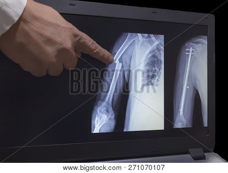 On The Monitor Screen Is Displayed An Xray Of Fracture Of A Hand With The Hand Of A Doctor Pointing 