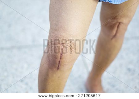 Asian Senior Or Elderly Old Lady Woman Patient Show Her Scars Surgical Total Knee Joint Replacement 