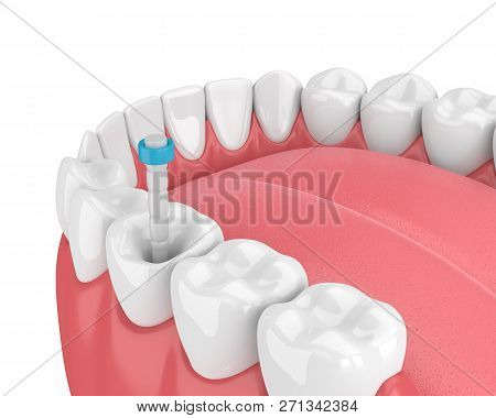 3D Render Of Jaw With Teeth And Fiber Post