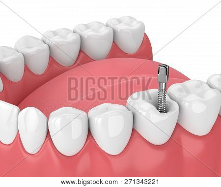 3d Render Of Jaw With Teeth And Dental Metal Post Over White. Endodontic Treatment Concept
