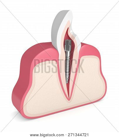 3d Render Of Tooth With Dental Metal Post Over White. Endodontic Treatment Concept