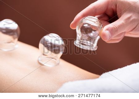 Therapist Placing Glass Cups On Woman's Back