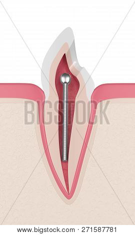 3d Render Of Tooth With Dental Stainless Steel Post In Gums. Endodontic Treatment Concept