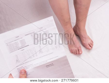 Doctor Holds Ultrasound Results Of Varicose Veins In An Elderly Woman, White Background, Close-up, P