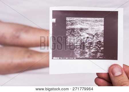 Doctor Holds In His Hand The Result Of Ultrasound Of The Veins Of The Legs, With Thrombophlebitis Of