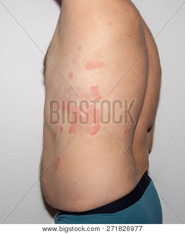Allergy. Health. Reaction. Histamine. Intolerance