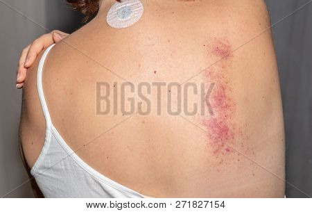 Bruise. Woman. Back. Medical. Treatment. Pain