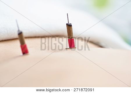 Woman Being Treated With Acupuncture And Moxibustion Treatments