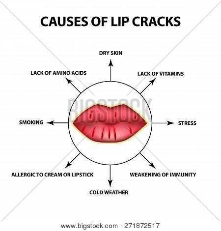 Causes Of Lip Cracks. Cracks In The Corners Of The Mouth. Infographics. Vector Illustration On Isola