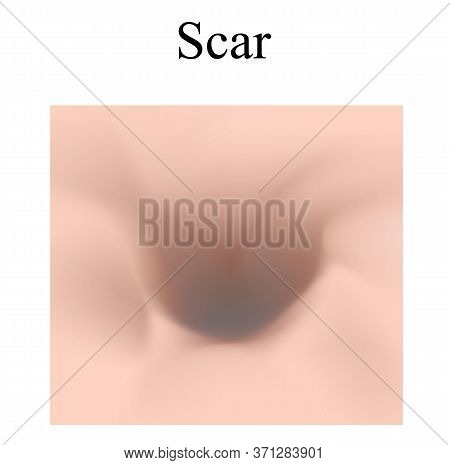 Atrophic Scars. Acne Scar. The Anatomical Structure Of The Skin With Acne. Illustration On Isolated 