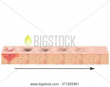 Atrophic Scars. Acne Scar. The Anatomical Structure Of The Skin With Acne. Illustration On Isolated 