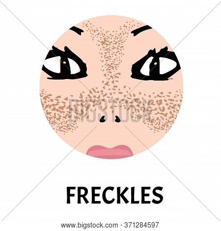 Freckles On The Face. Pigmentation On The Skin. A Pigmented Spot On The Skin Of The Face. Illustrati