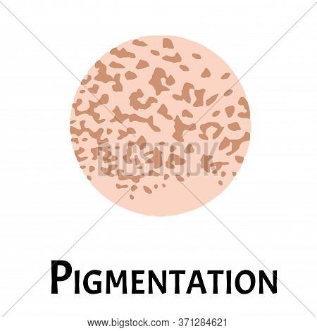 Pigmentation On The Skin. A Pigmented Spot On The Skin Of The Face. Illustration