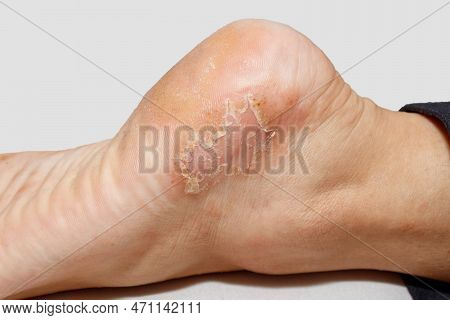 Dyshidrotic Eczema Skin Disease On Foot Heel Against White Background