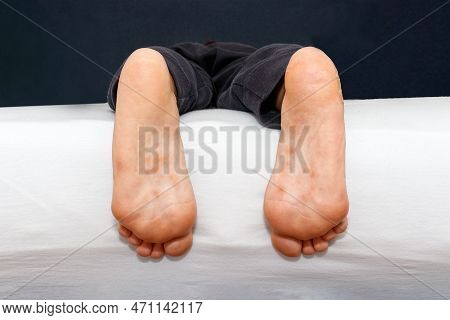 Dyshidrotic Eczema Skin Disease On Sole Of Foot Against White Background