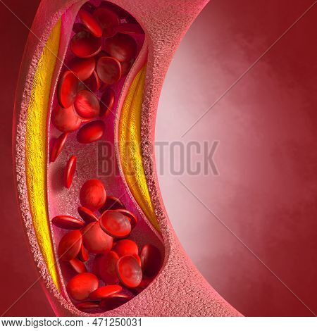 Medical Background, Cholesterol Plaque In The Artery, Increased Level, 3d Illustration