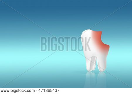 Unhealthy Tooth White Molar Model On Pastel Blue Background. Tooth Symbol Sign. Caries. Caries And D