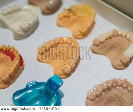 Plaster Casts Of The Jaws. Variety Of Samples In The Prosthetic Workshop.