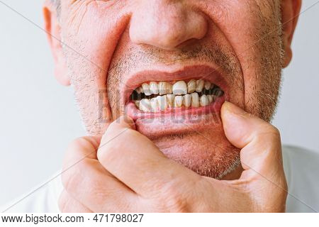 Teeth With Lot Of Tartar, Plaque. Malocclusion, Crooked Teeth. Concept Of Unhealthy Teeth In Need Of