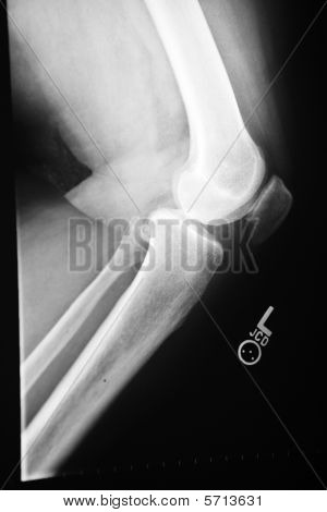 Kolano Xray