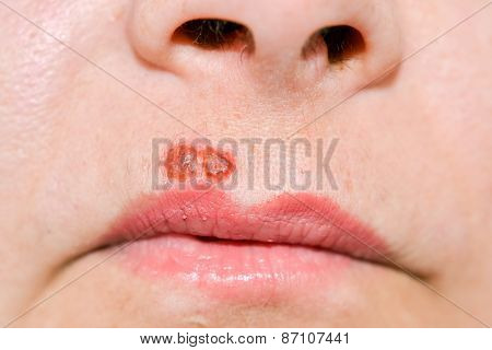 Herpes Virus