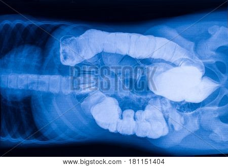 X-ray picture of the intestine with foreign bodies.