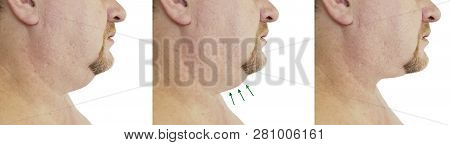 Submental Fat Man Before And After Procedures