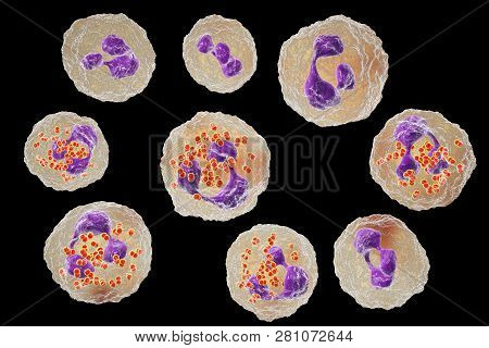 Bacteria Neisseria Gonorrhoeae Inside Neutrophils, Gonoccoccus, Diplococci That Cause Sexually Trans