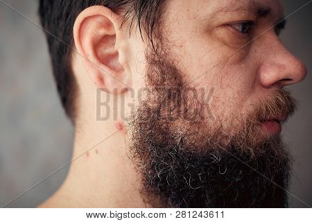 Festering Pimple On A Mans Neck, The Bearded Man Has Problems With Skin