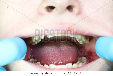 Operation Removal Of Wisdom Teeth - Eights. Stitching, Postoperative Period