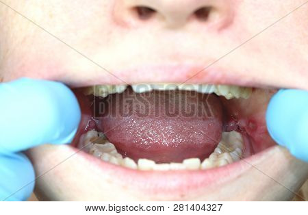 Operation Removal Of Wisdom Teeth - Eights. Stitching, Postoperative Period
