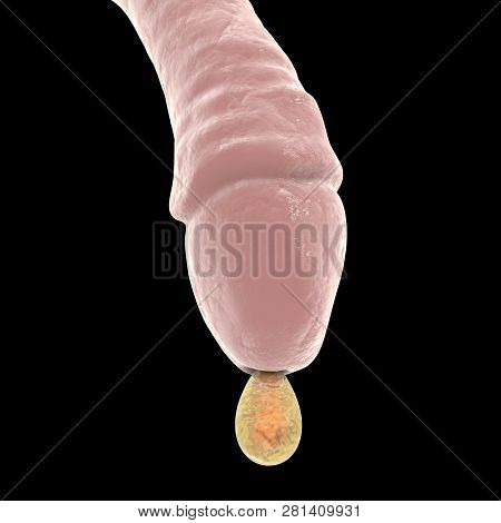 Male Gonorrhea, Medical Concept. 3d Illustration Showing Drop Of Pus Coming From Man Urethra, The Ma