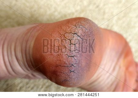 Human Heel Crack, Foot Health Problems, Neglected Heel Of A Human, Cracked Heels Human Foot,