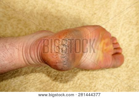 Human Heel Crack, Foot Health Problems, Neglected Heel Of A Human, Cracked Heels Human Foot,