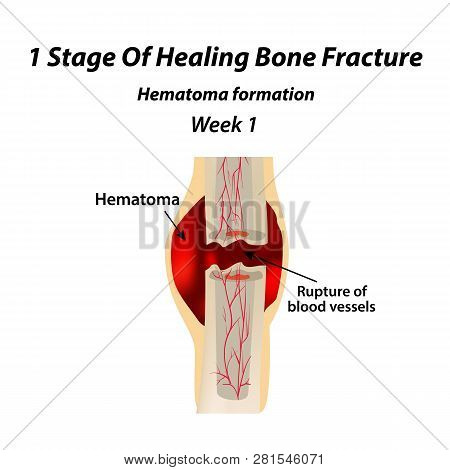 1 Stage Of Healing Bone Fracture. Formation Of Callus. The Bone Fracture. Infographics. Vector Illus