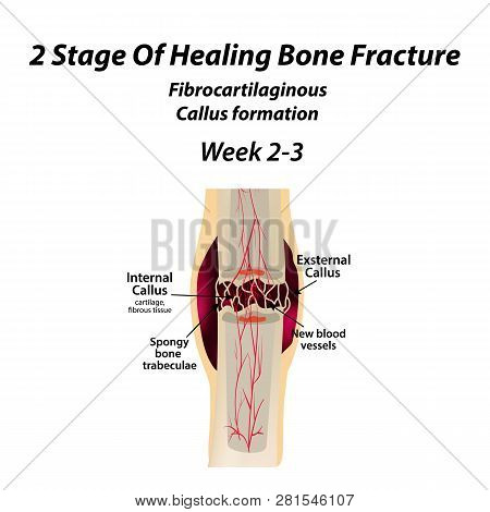 2 Stage Of Healing Bone Fracture. Formation Of Callus. The Bone Fracture. Infographics. Vector Illus