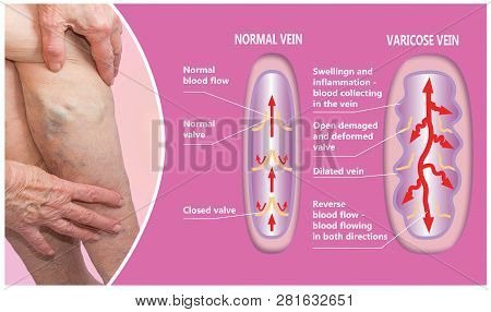 Varicose Veins On A Female Senior Legs. The Structure Of Normal And Varicose Veins. Concept Of Dry S